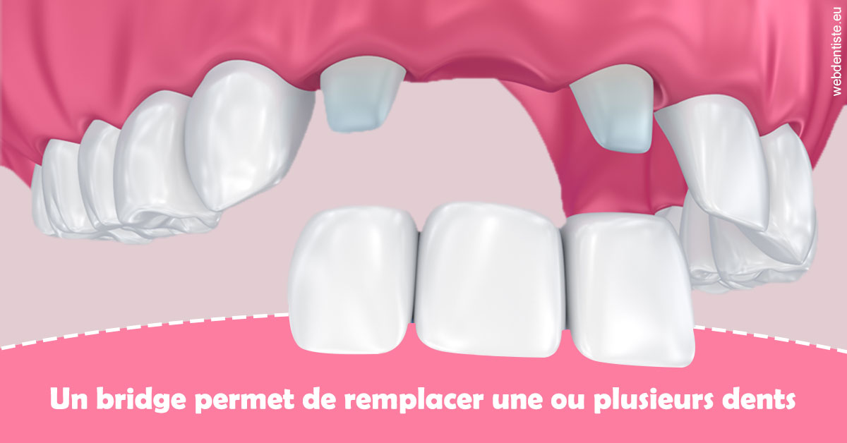 https://dr-morgane-pelletier.chirurgiens-dentistes.fr/Bridge remplacer dents 2