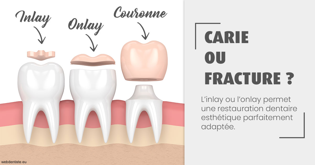 https://dr-morgane-pelletier.chirurgiens-dentistes.fr/T2 2023 - Carie ou fracture 1