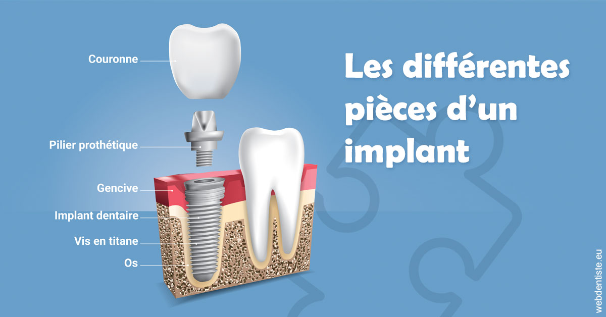 https://dr-morgane-pelletier.chirurgiens-dentistes.fr/Les différentes pièces d’un implant 1
